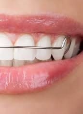 frenos-dentales