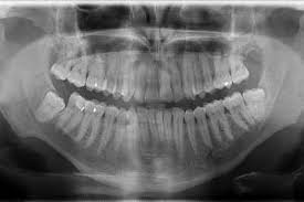 radiografias-dentales
