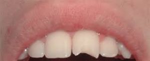 reconstruccion-dental