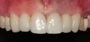 dientes-de-porcelana