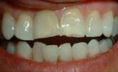 dientes-quebradizos
