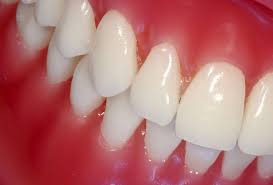 periodontitis-tratamiento