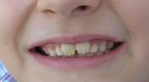 dientes-que-caen