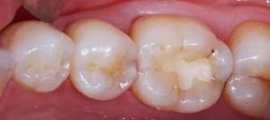 resina dental